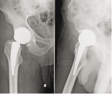 Controllo radiografico postoperatorio dopo impianto di protesi